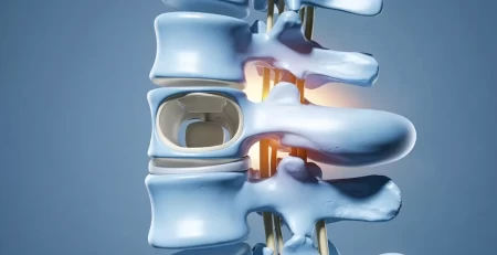 estenosis de columna o hernia discal Lima